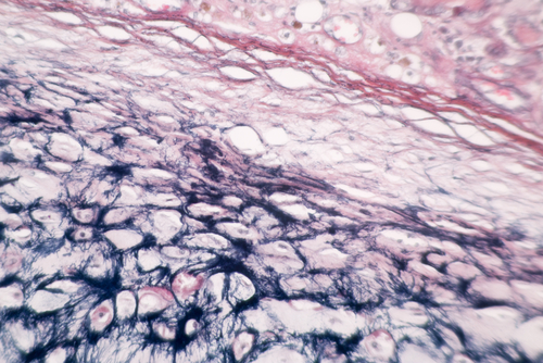 Spinal Muscular Atrophy: Muscle Biopsy