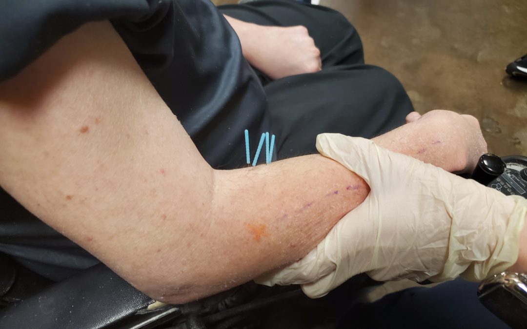 Using Dry Needling To Relieve Muscle Spasms For SMA Patients