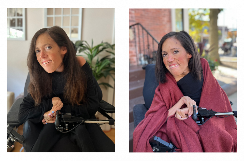 decisions and SMA | SMA News Today | A photo stitch shows Alyssa's hair before and after being cut and styled. On the right, Alyssa's hair is long, on the left, it's short