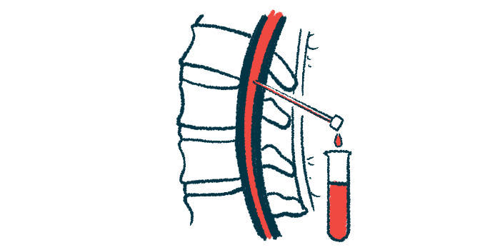 An illustration showing a spinal tap procedure.