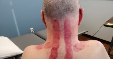 A man is shown with bruises on his neck and upper back from a cupping procedure.