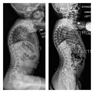 Two side-by-side photos show two X-ray images. Both are taken from the side and show a young girl's torso. The first image shows kyphosis, where the upper spine is rounded. In the second photo, the girl is standing straighter.
